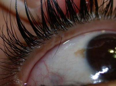 Ingrown Eyelash Removal
