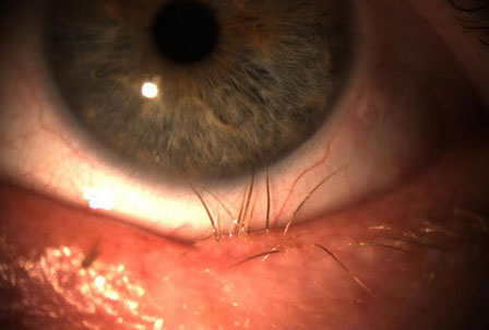 Ingrown Eyelash Removal